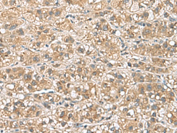 Immunohistochemistry of paraffin-embedded Human liver cancer tissue using PHLDA3 Polyclonal Antibody at dilution of 1:110(×200)