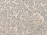 Immunohistochemistry of paraffin-embedded Human lung cancer tissue using FYTTD1 Polyclonal Antibody at dilution of 1:30(×200)