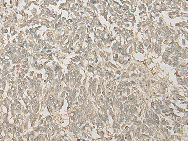 Immunohistochemistry of paraffin-embedded Human lung cancer tissue using FYTTD1 Polyclonal Antibody at dilution of 1:30(×200)