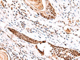Immunohistochemistry of paraffin-embedded Human esophagus cancer tissue using IRF2BP1 Polyclonal Antibody at dilution of 1:30(×200)
