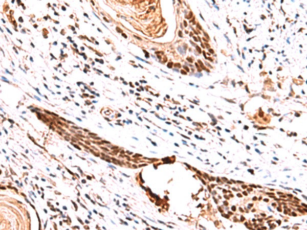 Immunohistochemistry of paraffin-embedded Human esophagus cancer tissue using IRF2BP1 Polyclonal Antibody at dilution of 1:30(×200)