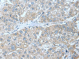 Immunohistochemistry of paraffin-embedded Human liver cancer tissue using SRPK2 Polyclonal Antibody at dilution of 1:55(×200)