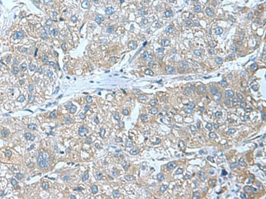 Immunohistochemistry of paraffin-embedded Human liver cancer tissue using SRPK2 Polyclonal Antibody at dilution of 1:55(×200)