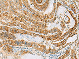 Immunohistochemistry of paraffin-embedded Human thyroid cancer tissue using FARP2 Polyclonal Antibody at dilution of 1:70(×200)