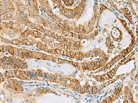 Immunohistochemistry of paraffin-embedded Human thyroid cancer tissue using FARP2 Polyclonal Antibody at dilution of 1:70(×200)