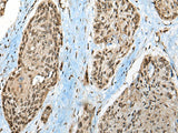 Immunohistochemistry of paraffin-embedded Human esophagus cancer tissue using CCDC12 Polyclonal Antibody at dilution of 1:50(×200)