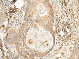 Immunohistochemistry of paraffin-embedded Human esophagus cancer tissue using ZNF397 Polyclonal Antibody at dilution of 1:80(×200)