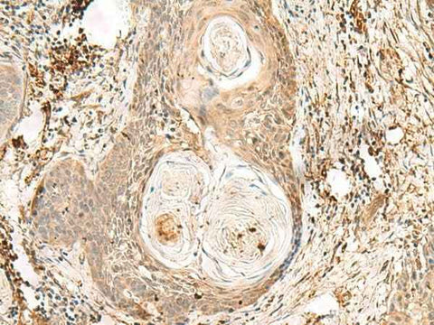 Immunohistochemistry of paraffin-embedded Human esophagus cancer tissue using ZNF397 Polyclonal Antibody at dilution of 1:80(×200)