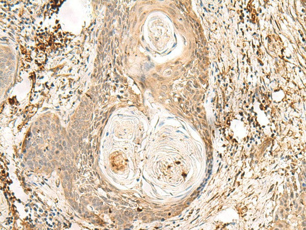 Immunohistochemistry of paraffin-embedded Human esophagus cancer tissue using ZNF397 Polyclonal Antibody at dilution of 1:80(×200)