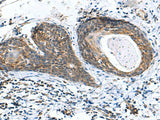 Immunohistochemistry of paraffin-embedded Human esophagus cancer tissue using AP1S3 Polyclonal Antibody at dilution of 1:70(×200)