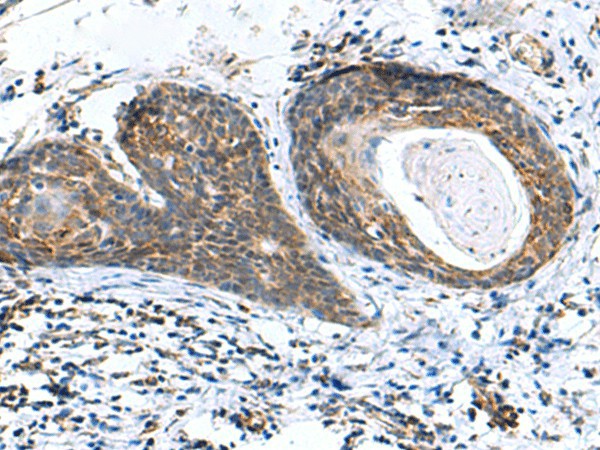 Immunohistochemistry of paraffin-embedded Human esophagus cancer tissue using AP1S3 Polyclonal Antibody at dilution of 1:70(×200)