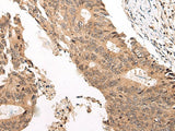 Immunohistochemistry of paraffin-embedded Human colorectal cancer tissue using CHAMP1 Polyclonal Antibody at dilution of 1:40(×200)