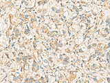 Immunohistochemistry of paraffin-embedded Human liver cancer tissue using IDS Polyclonal Antibody at dilution of 1:60(×200)