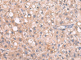 Immunohistochemistry of paraffin-embedded Human liver cancer tissue using JAZF1 Polyclonal Antibody at dilution of 1:55(×200)