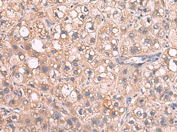 Immunohistochemistry of paraffin-embedded Human liver cancer tissue using JAZF1 Polyclonal Antibody at dilution of 1:55(×200)