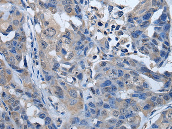 Immunohistochemistry of paraffin-embedded Human breast cancer tissue using PLK4 Polyclonal Antibody at dilution of 1:50(×200)