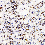 Immunohistochemistry analysis of paraffin-embedded human lung cancer using HDAC2 Polyclonal Antibody at dilution of 1:1000.