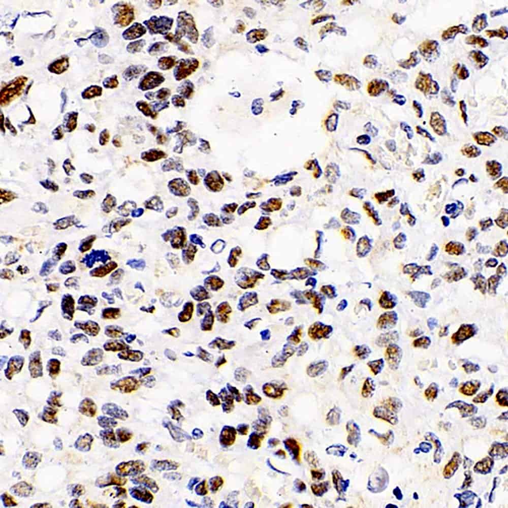 Immunohistochemistry analysis of paraffin-embedded human lung cancer using HDAC2 Polyclonal Antibody at dilution of 1:1000.