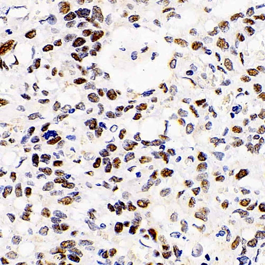 Immunohistochemistry analysis of paraffin-embedded human lung cancer using HDAC2 Polyclonal Antibody at dilution of 1:1000.