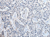 Immunohistochemistry of paraffin-embedded Human lung cancer tissue using PPIG Polyclonal Antibody at dilution of 1:50(×200)