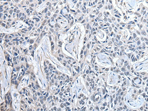 Immunohistochemistry of paraffin-embedded Human lung cancer tissue using PPIG Polyclonal Antibody at dilution of 1:50(×200)