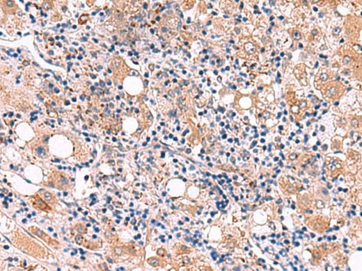 Immunohistochemistry of paraffin-embedded Human liver cancer tissue using LIPA Polyclonal Antibody at dilution of 1:50(×200)