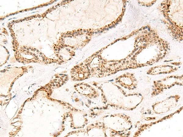 Immunohistochemistry of paraffin-embedded Human thyroid cancer tissue using DCAF10 Polyclonal Antibody at dilution of 1:55(×200)