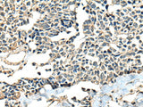 Immunohistochemistry of paraffin-embedded Human lung cancer tissue using CALHM1 Polyclonal Antibody at dilution of 1:60(×200)