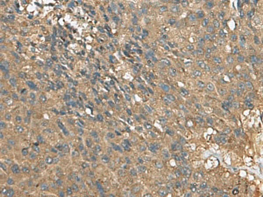 Immunohistochemistry of paraffin-embedded Human liver cancer tissue using EIF1AX Polyclonal Antibody at dilution of 1:105(×200)