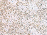 Immunohistochemistry of paraffin-embedded Human ovarian cancer tissue using SMNDC1 Polyclonal Antibody at dilution of 1:50(×200)