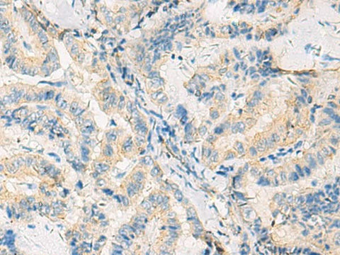 Immunohistochemistry of paraffin-embedded Human thyroid cancer tissue using SYNGR1 Polyclonal Antibody at dilution of 1:50(×200)