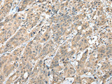 Immunohistochemistry of paraffin-embedded Human colorectal cancer tissue using HIF1A Polyclonal Antibody at dilution of 1:45(×200)