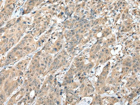 Immunohistochemistry of paraffin-embedded Human colorectal cancer tissue using HIF1A Polyclonal Antibody at dilution of 1:45(×200)