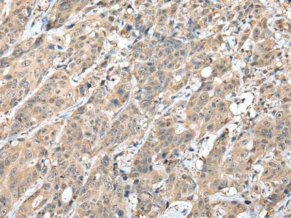 Immunohistochemistry of paraffin-embedded Human colorectal cancer tissue using HIF1A Polyclonal Antibody at dilution of 1:45(×200)