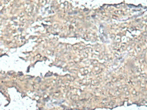 Immunohistochemistry of paraffin-embedded Human ovarian cancer tissue using MEF2D Polyclonal Antibody at dilution of 1:50(×200)