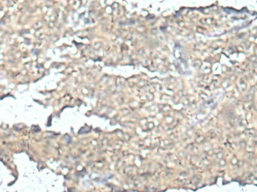Immunohistochemistry of paraffin-embedded Human ovarian cancer tissue using MEF2D Polyclonal Antibody at dilution of 1:50(×200)