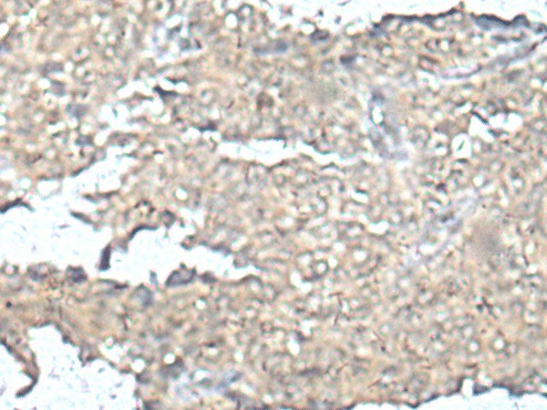 Immunohistochemistry of paraffin-embedded Human ovarian cancer tissue using MEF2D Polyclonal Antibody at dilution of 1:50(×200)