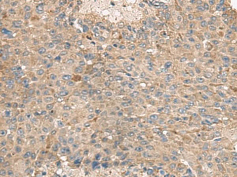 Immunohistochemistry of paraffin-embedded Human liver cancer tissue using ABCA10 Polyclonal Antibody at dilution of 1:50(×200)