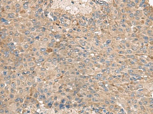 Immunohistochemistry of paraffin-embedded Human liver cancer tissue using ABCA10 Polyclonal Antibody at dilution of 1:50(×200)