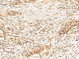 Immunohistochemistry of paraffin-embedded Human esophagus cancer tissue using SETMAR Polyclonal Antibody at dilution of 1:100(×200)