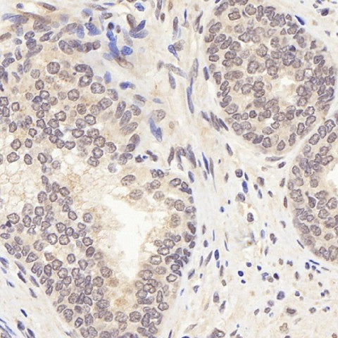 Immunohistochemistry analysis of paraffin-embedded human Prostate using AR Polyclonal Antibody at dilution of 1:300.