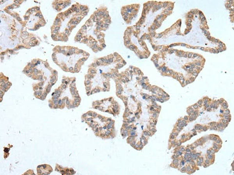 Immunohistochemistry of paraffin-embedded Human thyroid cancer tissue using ABCD1 Polyclonal Antibody at dilution of 1:80(×200)
