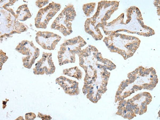 Immunohistochemistry of paraffin-embedded Human thyroid cancer tissue using ABCD1 Polyclonal Antibody at dilution of 1:80(×200)
