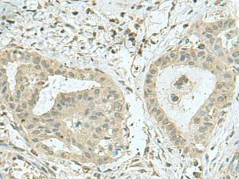Immunohistochemistry of paraffin-embedded Human thyroid cancer tissue using THTPA Polyclonal Antibody at dilution of 1:70(×200)