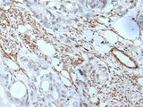 Immunohistochemistry of paraffin-embedded Human colorectal cancer tissue using GJA5 Polyclonal Antibody at dilution of 1:50(×200)