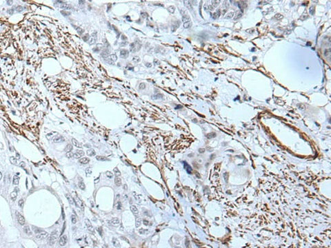 Immunohistochemistry of paraffin-embedded Human colorectal cancer tissue using GJA5 Polyclonal Antibody at dilution of 1:50(×200)