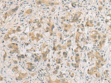 Immunohistochemistry of paraffin-embedded Human liver cancer tissue using RTP4 Polyclonal Antibody at dilution of 1:80(×200)