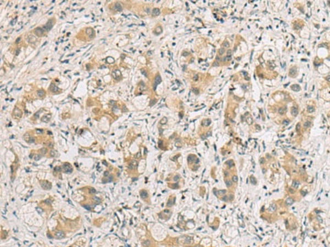 Immunohistochemistry of paraffin-embedded Human liver cancer tissue using RTP4 Polyclonal Antibody at dilution of 1:80(×200)