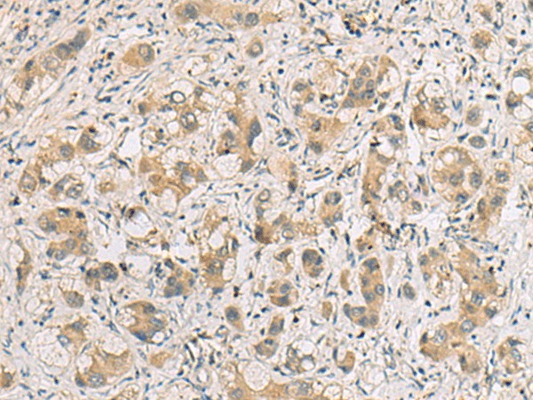 Immunohistochemistry of paraffin-embedded Human liver cancer tissue using RTP4 Polyclonal Antibody at dilution of 1:80(×200)