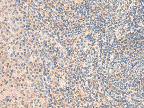 Immunohistochemistry of paraffin-embedded Human tonsil tissue using GRM2 Polyclonal Antibody at dilution of 1:50(×200)